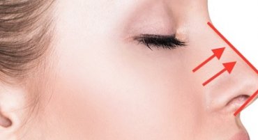 ניתוח אף פתוח