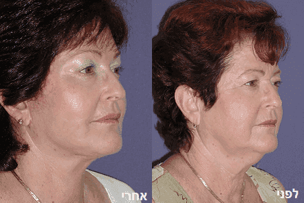 ניתוח מתיחת פנים